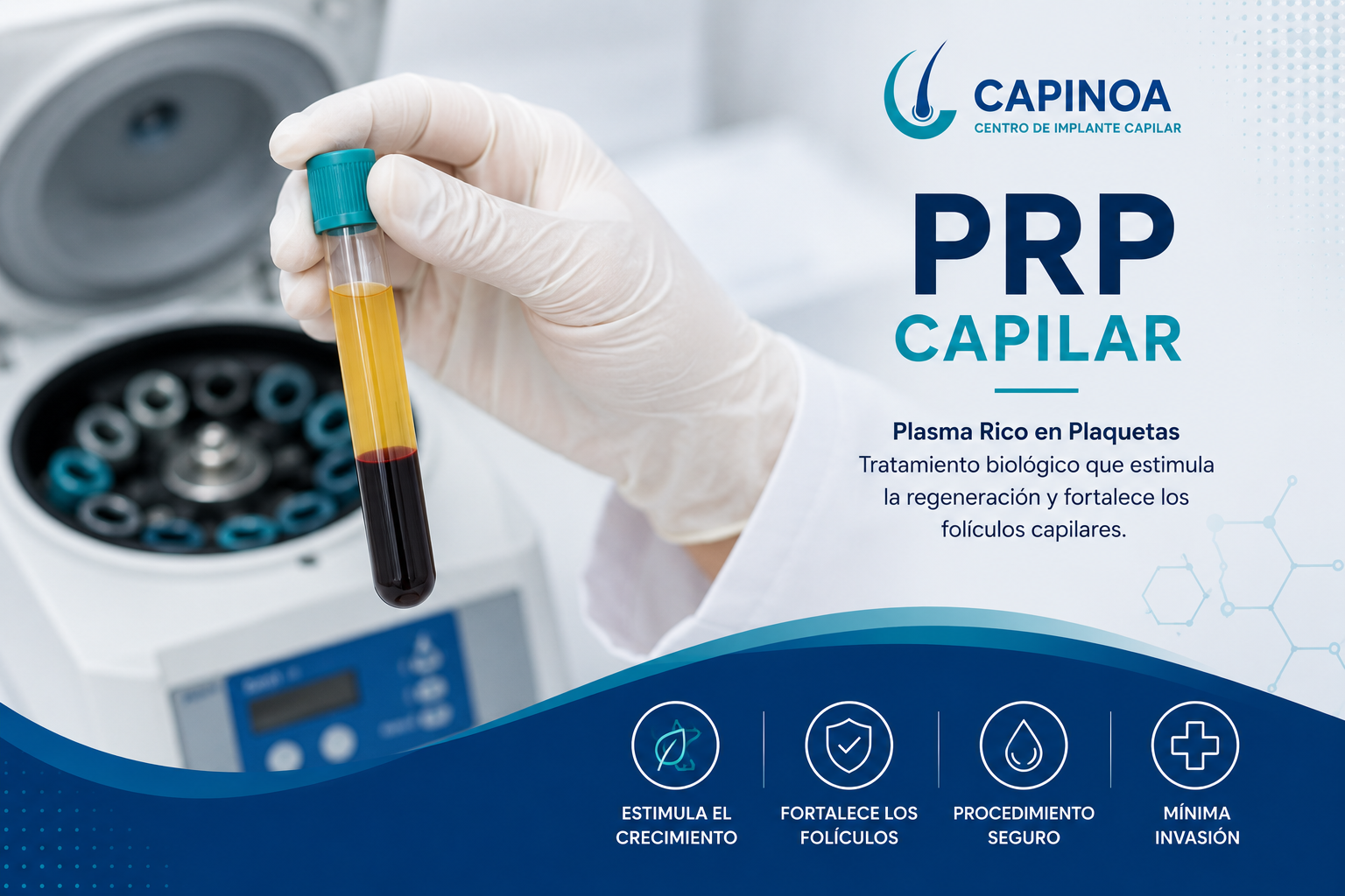 Tratamiento de Plasma Rico en Plaquetas